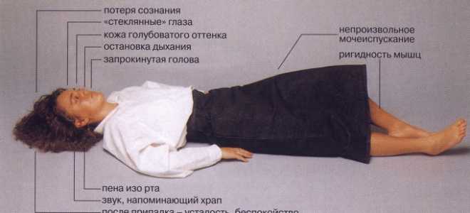 Эпилепсия